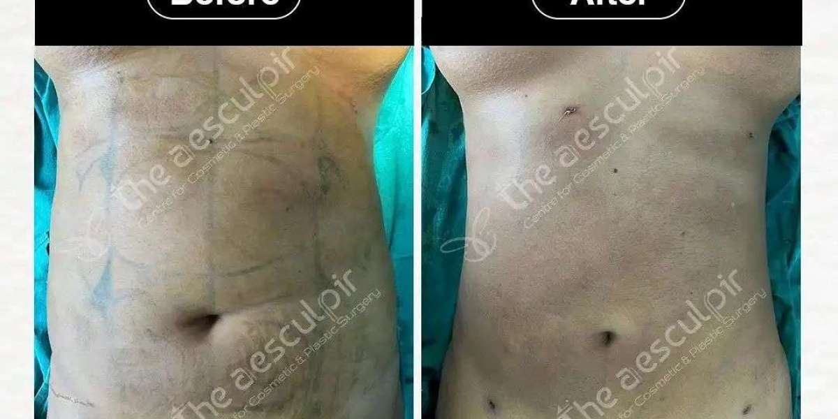 Discover Affordable Liposuction Surgery Cost in India with the Best Plastic Surgeon at Theaesculpir