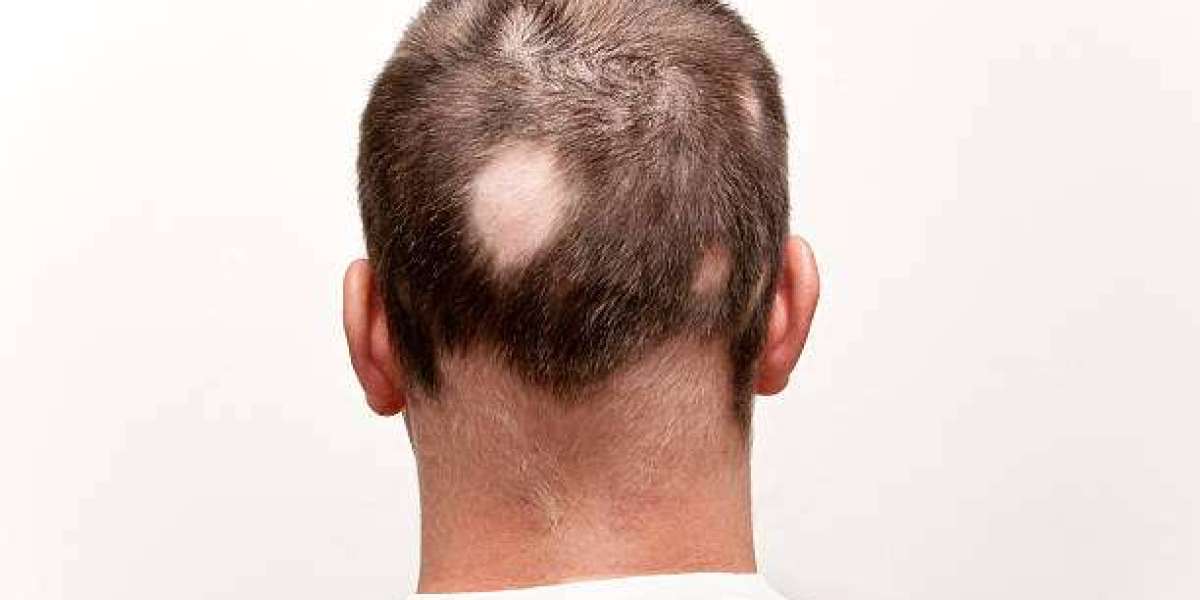Know All About Alopecia Treatment Market For 2025