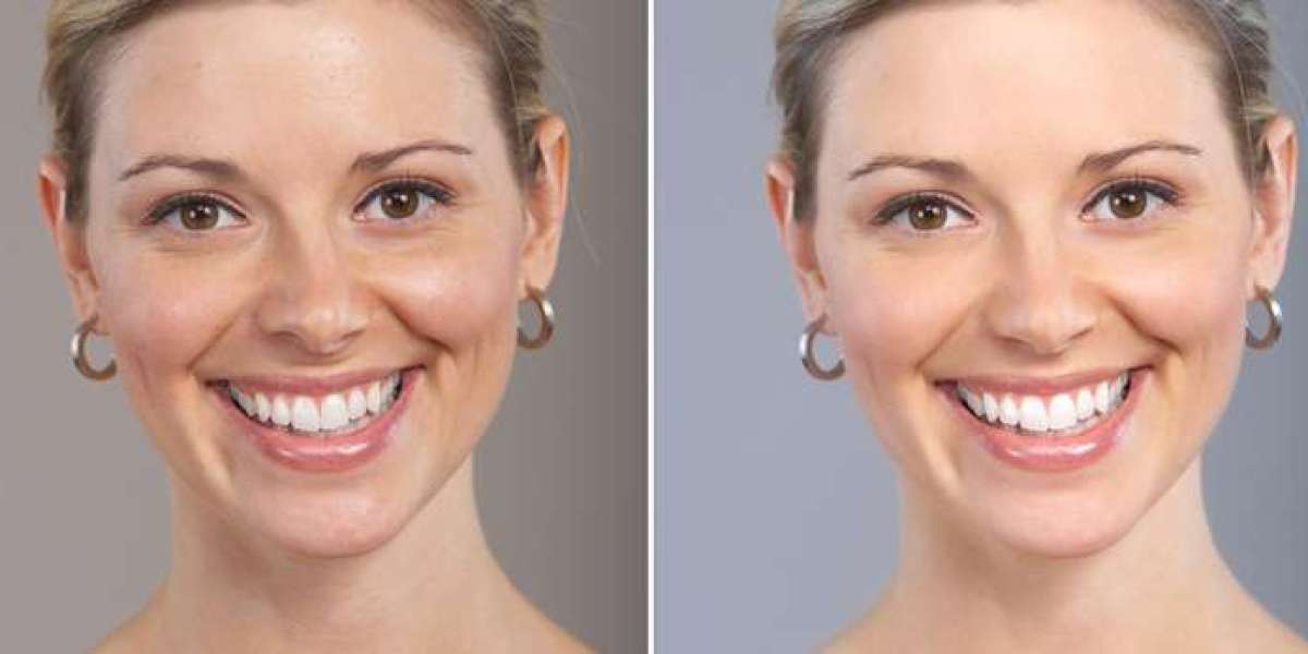 Skin Lightening Treatment in Delhi: Expert Solutions from Medlinks & Top Dermatologists in Gurgaon