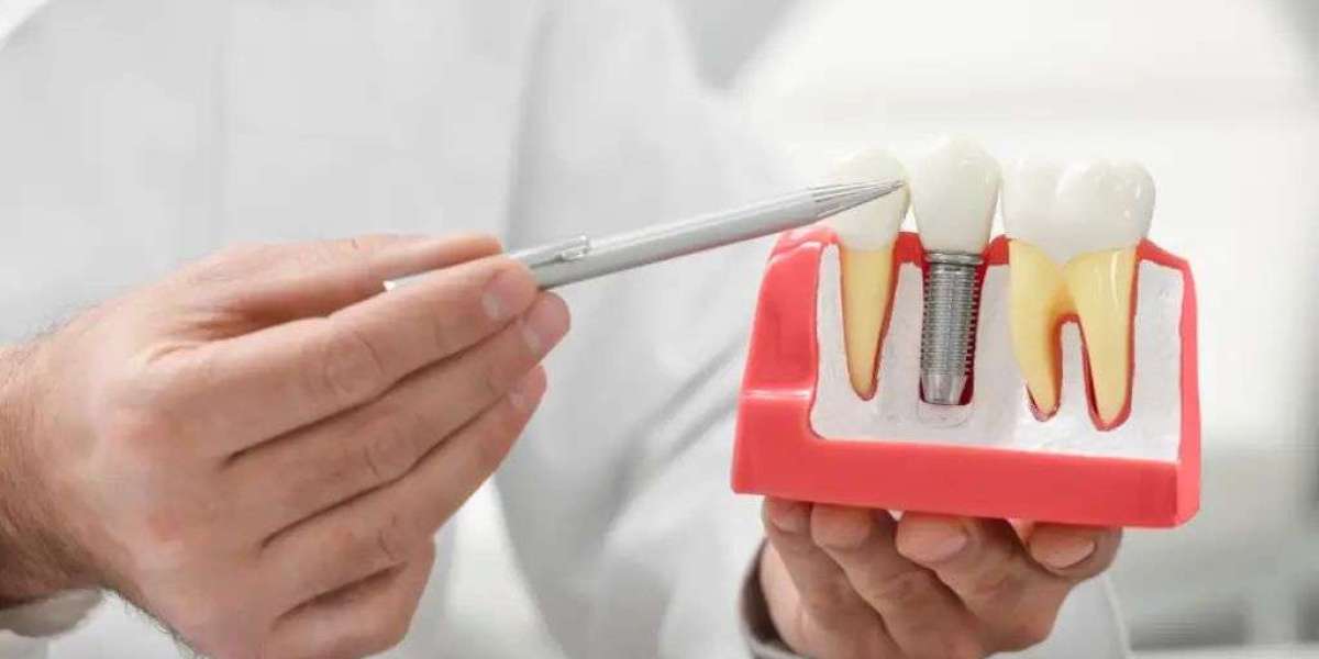 Why Dental Implants in Dubai Are Changing the Way People Restore Their Smiles