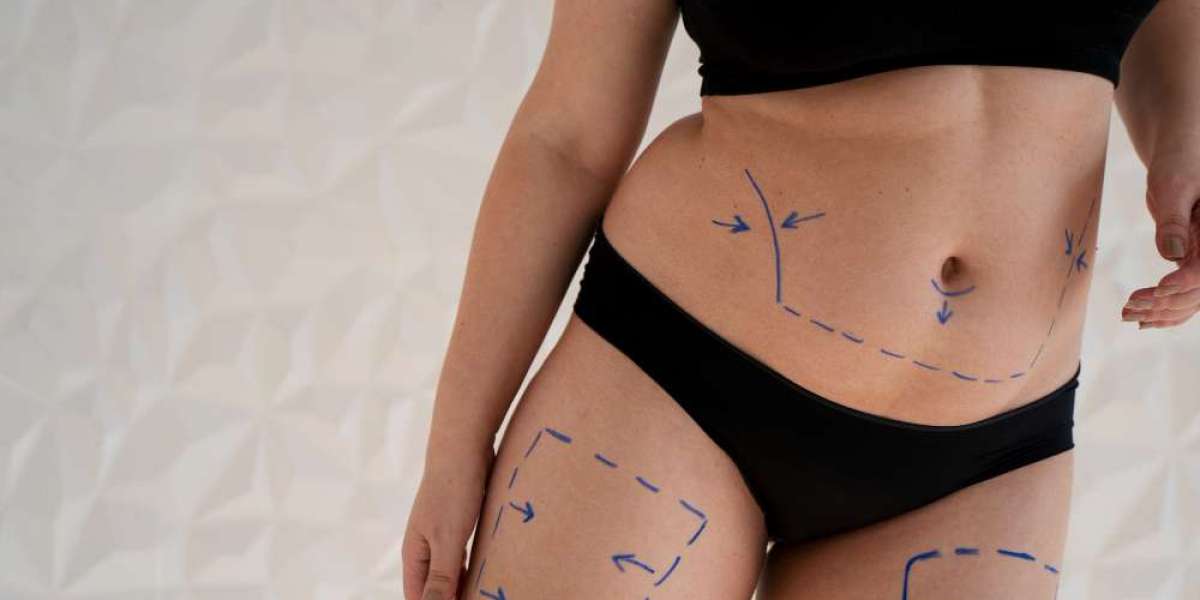 The Complete Patient Journey for Liposuction in Dubai: Consultation to Recovery