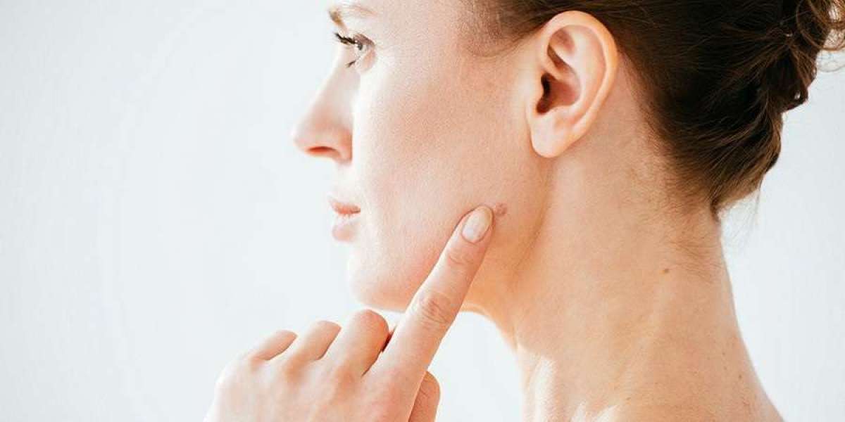 Can Mole Removal Be Done Comfortably?