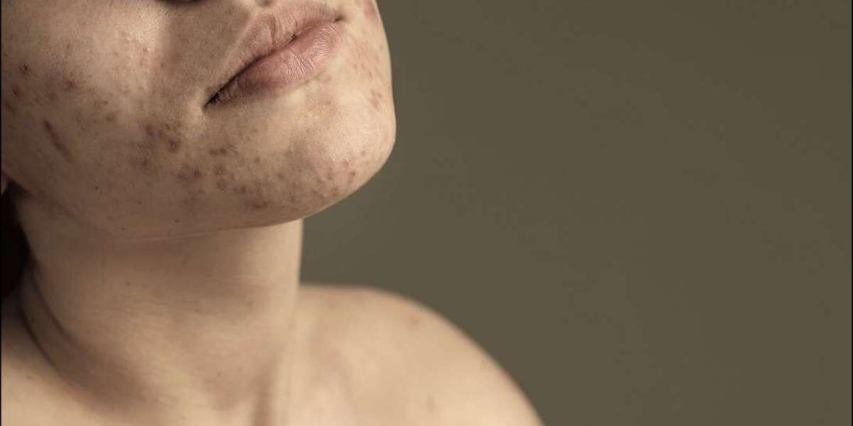 Acne Treatment in Kalyan Nagar: Clear Skin Solutions at Neotis Skin Clinic