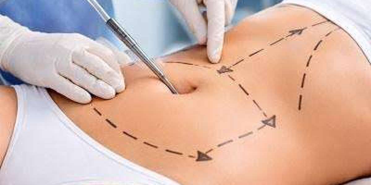 Vaser Liposuction Surgery in Dubai: Why Modern Technology Makes a Difference