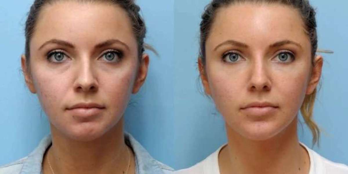 Best Doctors in Dubai: Thread Lift for Enhancing Facial Definition