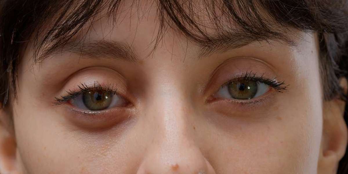 Recovery After Eyelid Bag Surgery Dubai: What to Expect