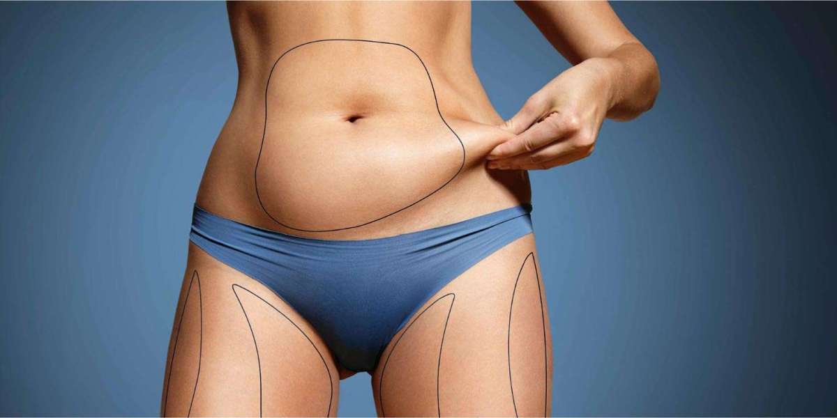 Abdominoplasty Dubai: Preparing for a Safe and Successful Surgery