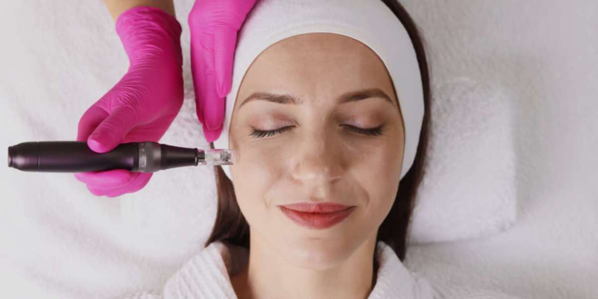 Microneedling Vaughan: A Complete Guide to Healthier, Smoother, and More Radiant Skin