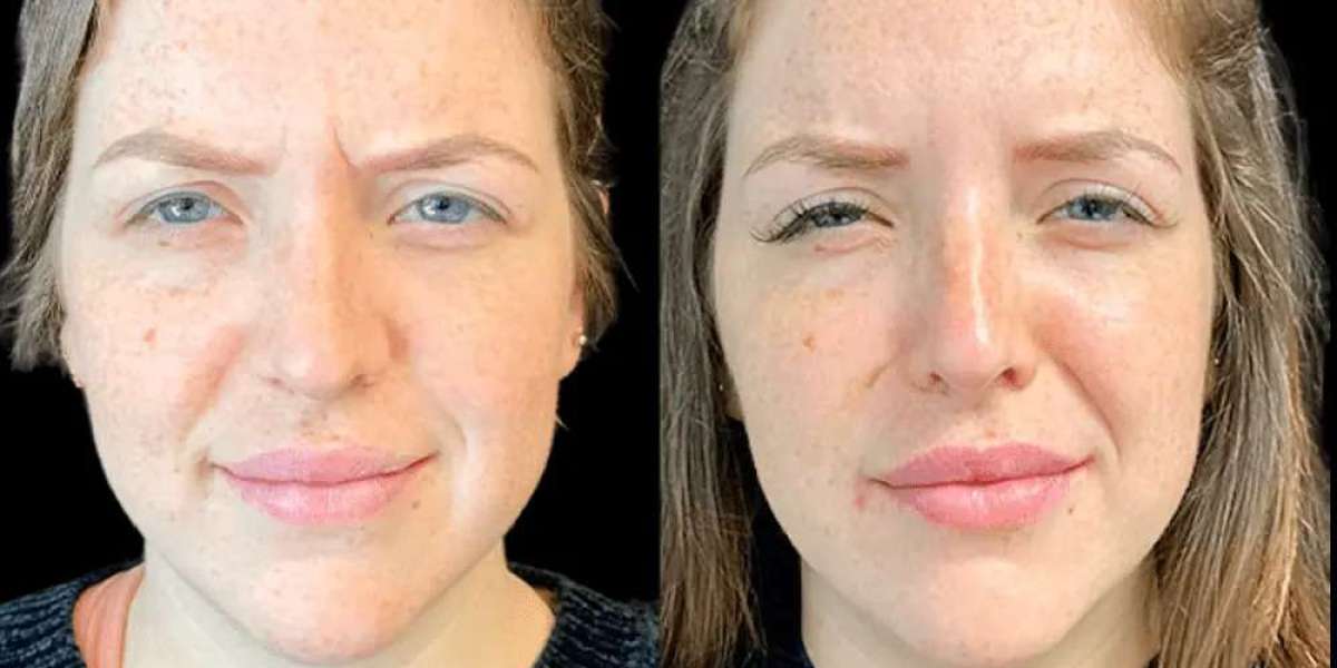 Best Plastic Surgeon in Dubai: How Long Do Botox Results Last?