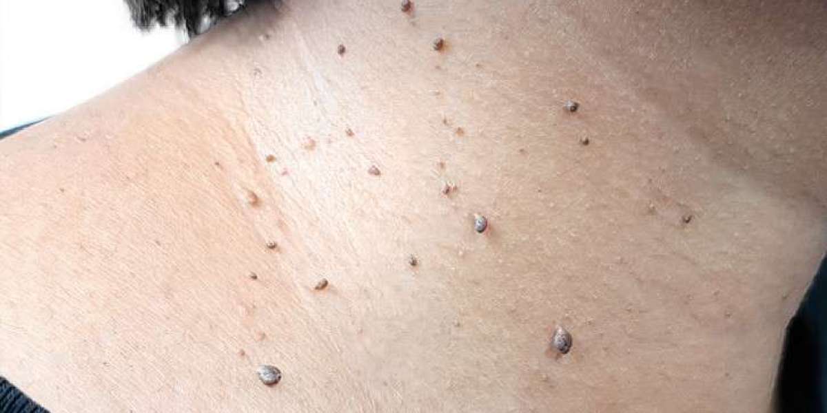 Skin Tag Removal in London: Understanding the Removal Process