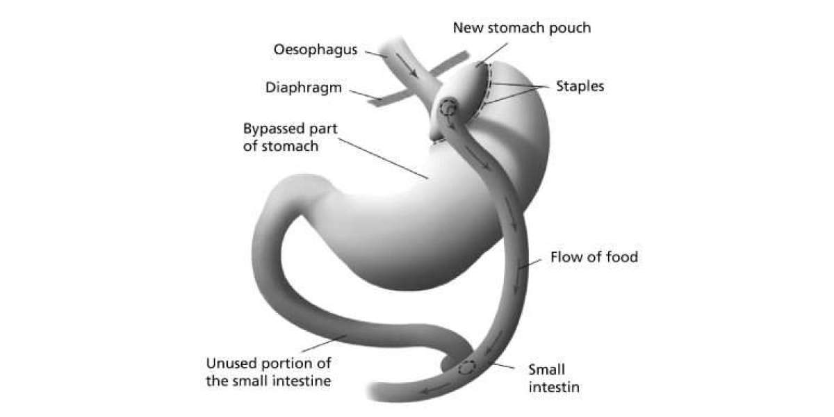 Pain After Gastric Bypass Surgery What Is Normal and When
