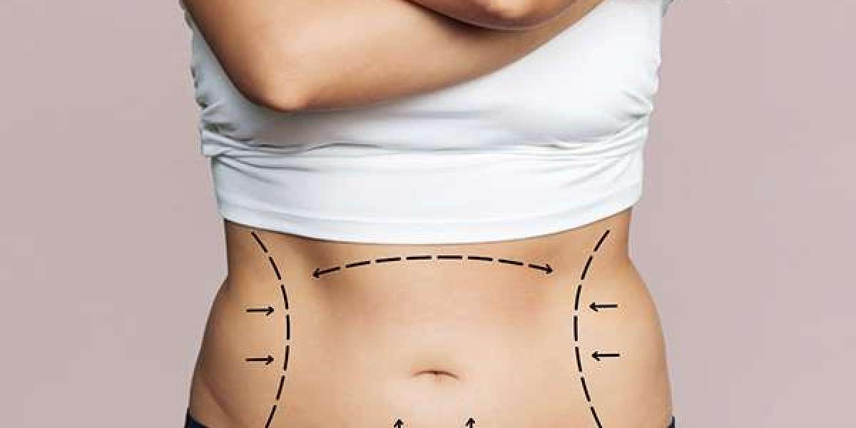 Tummy Tuck Dubai: What Can You Expect After Surgery?