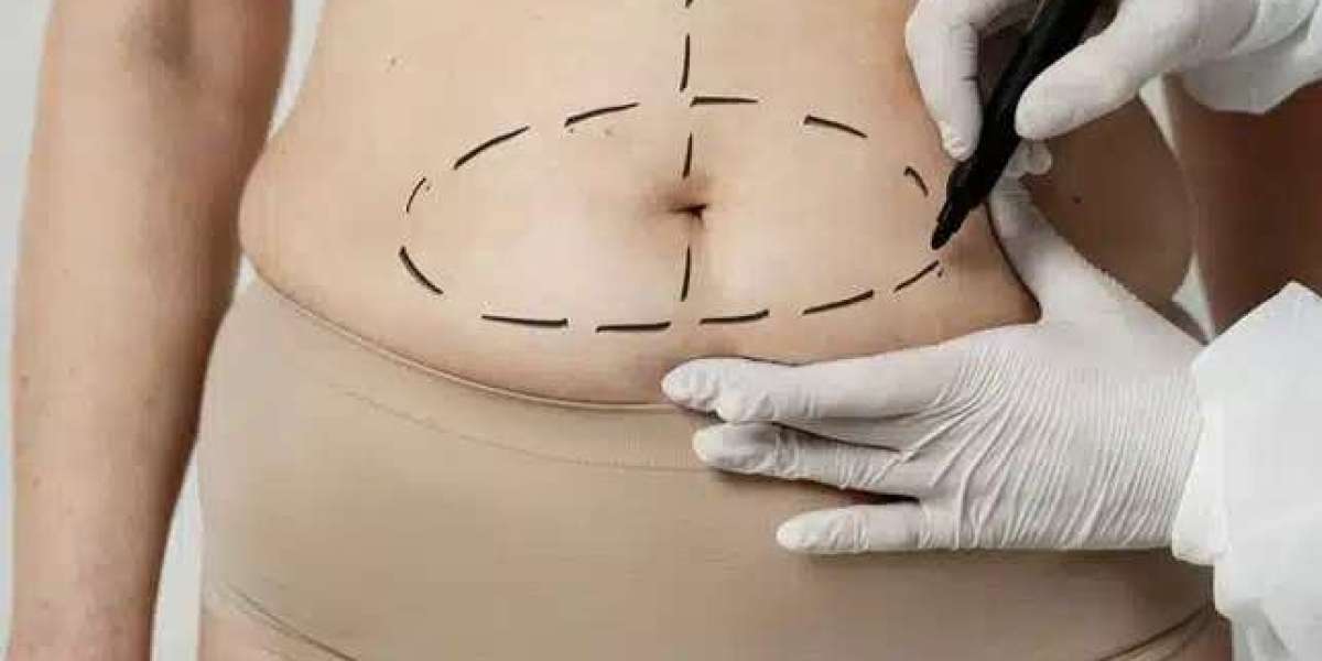 Tummy Tuck in Dubai vs Liposuction: Which Procedure Right for You?