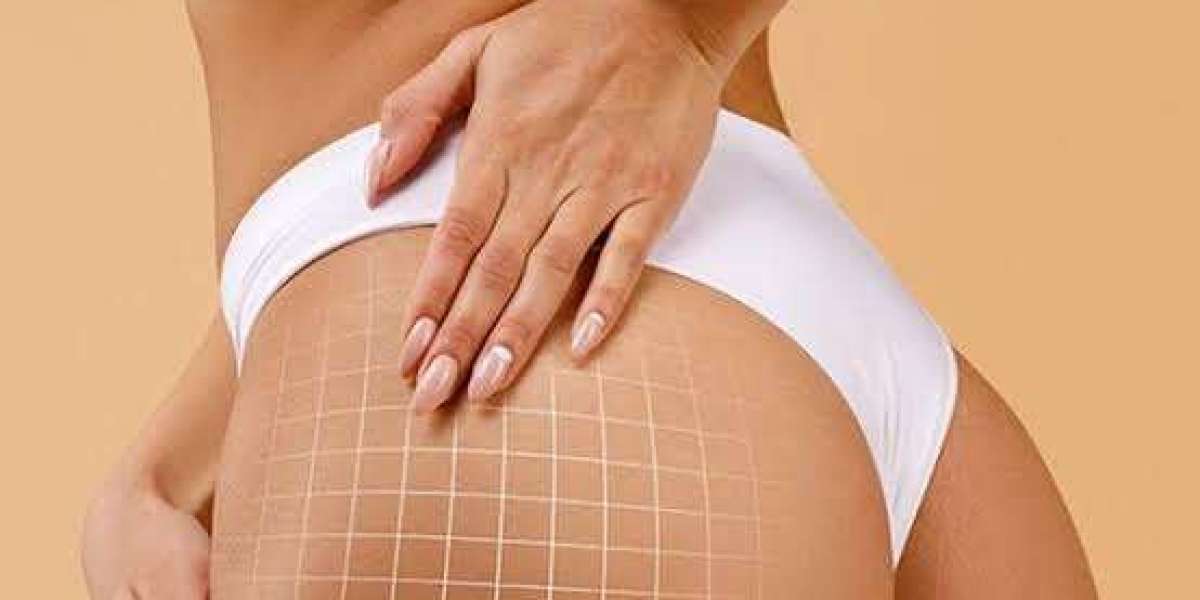 Butt Fillers in Dubai: Improve Shape, Volume and Definition