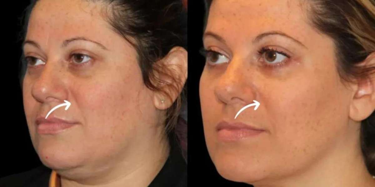 Best Aesthetic Clinics in Dubai for Sculptra Hairline Rejuvenation