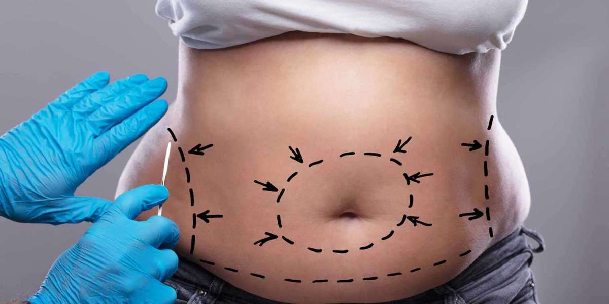 Common Myths About Tummy Tuck in Dubai