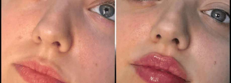 dermal fillers Cover Image