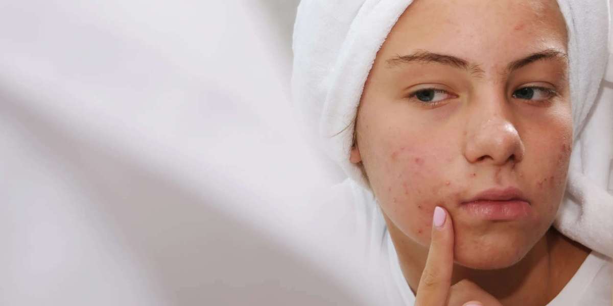 Acne Scar Removal in Dubai: Realistic Results Explained