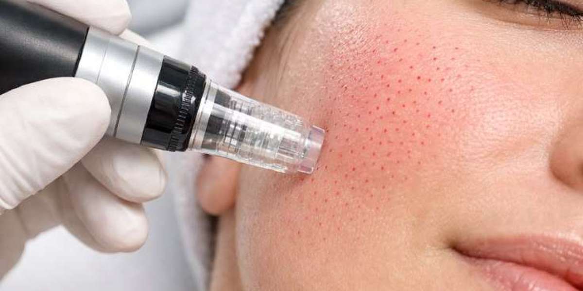 Microneedling in islamabad
