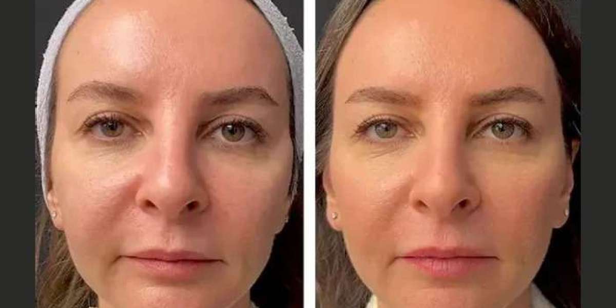 Mesotherapy Treatment in Dubai: How to Choose a Qualified Provider