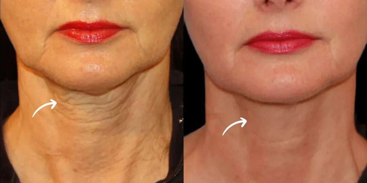 Best Aesthetic Clinics in Dubai for Sculptra Fillers Collagen Planning